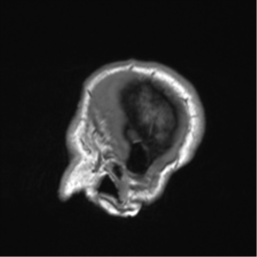 Clival chordoma invading the hypoglossal canal (Radiopaedia 48850-53887 Sagittal T1 12).png