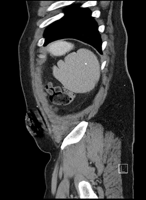 Closed loop obstruction - internal hernia into nephrectomy bed (Radiopaedia 59867-67320 C 3).jpg