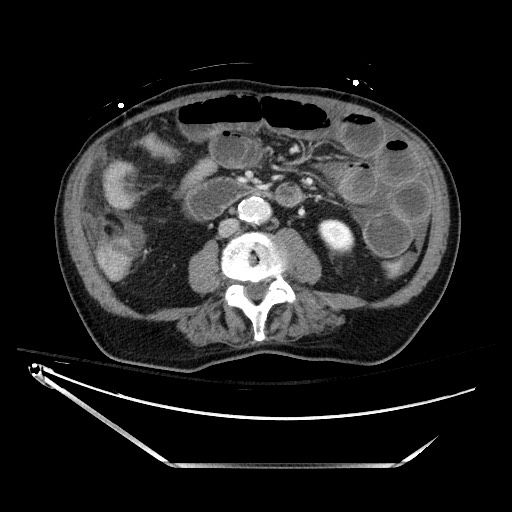 File:Closed loop obstruction due to adhesive band, resulting in small bowel ischemia and resection (Radiopaedia 83835-99023 Axial 397).jpg