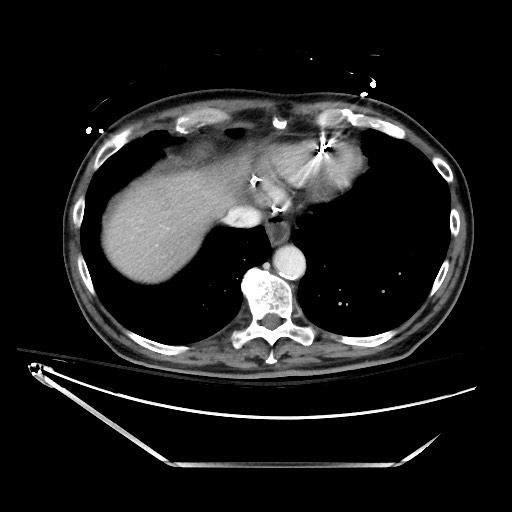 File:Closed loop obstruction due to adhesive band, resulting in small bowel ischemia and resection (Radiopaedia 83835-99023 D 21).jpg