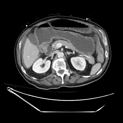 File:Closed loop obstruction due to adhesive band, resulting in small bowel ischemia and resection (Radiopaedia 83835-99023 D 55).jpg