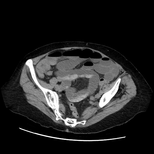 File:Closed loop small bowel obstruction due to adhesive band, with intramural hemorrhage and ischemia (Radiopaedia 83831-99017 Axial non-contrast 124).jpg