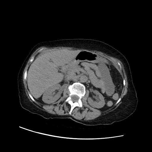 Closed loop small bowel obstruction due to adhesive band, with intramural hemorrhage and ischemia (Radiopaedia 83831-99017 Axial non-contrast 62).jpg