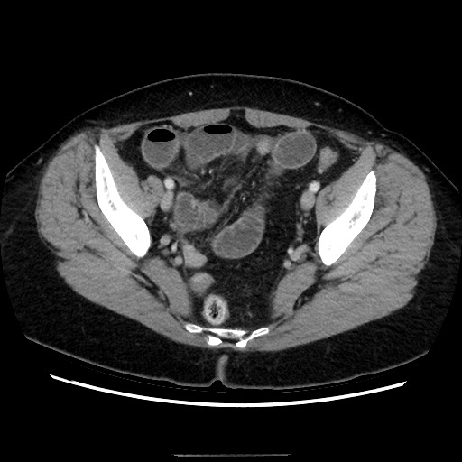 Closed loop small bowel obstruction due to adhesive bands - early and late images (Radiopaedia 83830-99015 A 139).jpg
