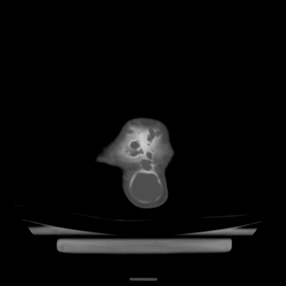 Cloverleaf skull (Radiopaedia 91901-109710 Axial bone window 141).jpg