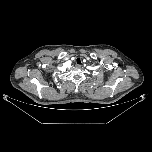 File:Coarctation of aorta (Radiopaedia 25384-25630 A 3).jpg