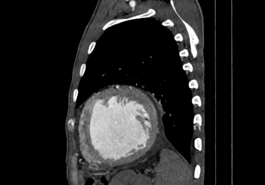 Coarctation of aorta with aortic valve stenosis (Radiopaedia 70463-80574 B 176).jpg