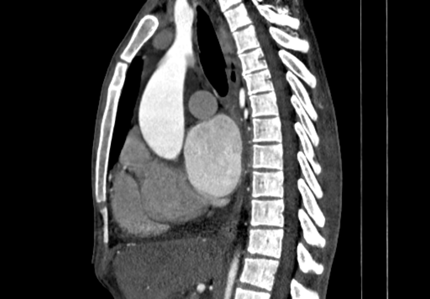 Coarctation of aorta with aortic valve stenosis (Radiopaedia 70463-80574 B 51).jpg