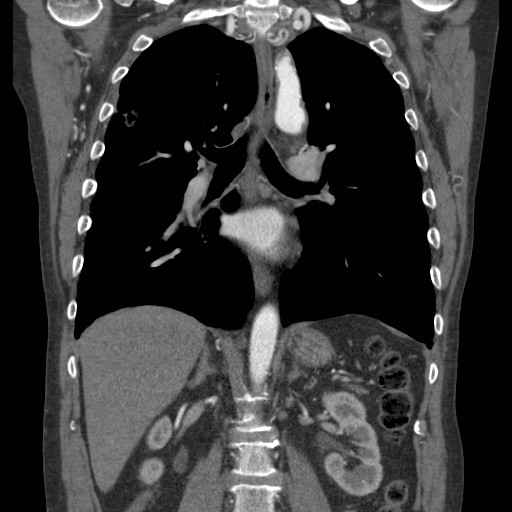 File:Coarctation of the aorta (Radiopaedia 17427-17116 A 40).jpg