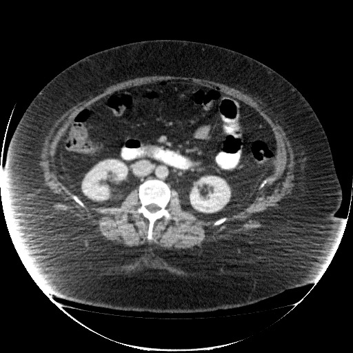 File:Collection due to leak after sleeve gastrectomy (Radiopaedia 55504-61972 A 39).jpg