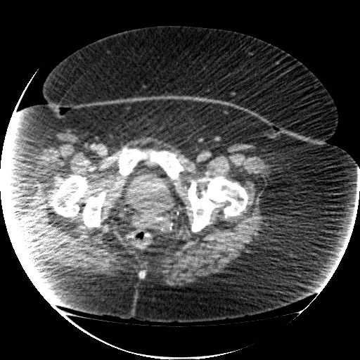 File:Collection due to leak after sleeve gastrectomy (Radiopaedia 55504-61972 A 79).jpg
