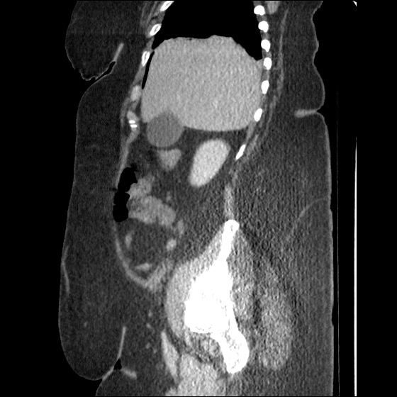 File:Collection due to leak after sleeve gastrectomy (Radiopaedia 55504-61972 C 47).jpg