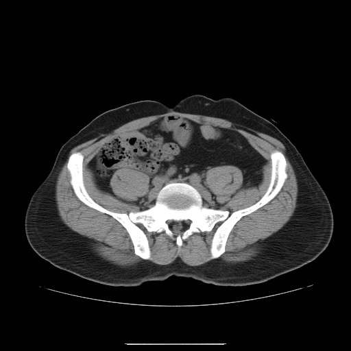 File:Colocutaneous fistula in Crohn's disease (Radiopaedia 29586-30093 Axial non-contrast 25).jpg