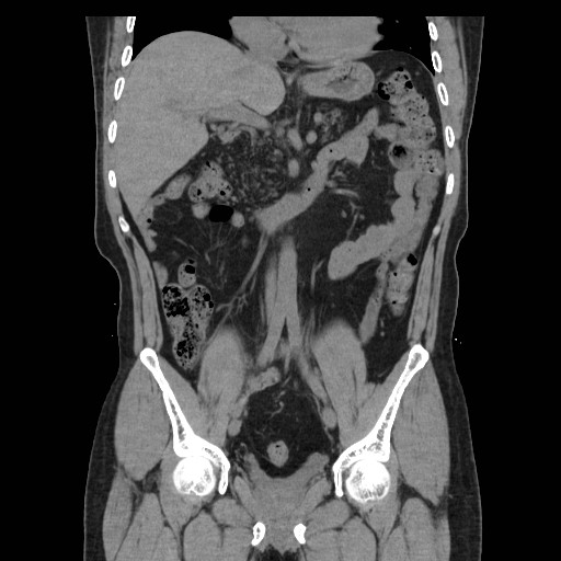 File:Colocutaneous fistula in Crohn's disease (Radiopaedia 29586-30093 Coronal non-contrast 14).jpg