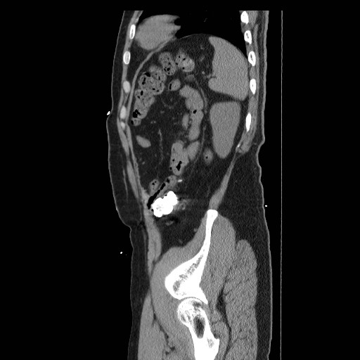 Colocutaneous fistula in Crohn's disease (Radiopaedia 29586-30093 F 44).jpg