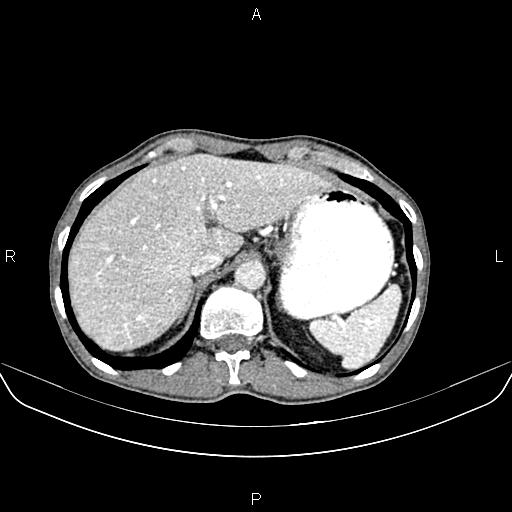 Colon adenocarcinoma - hepatic flexure (Radiopaedia 85635-101395 A 19).jpg