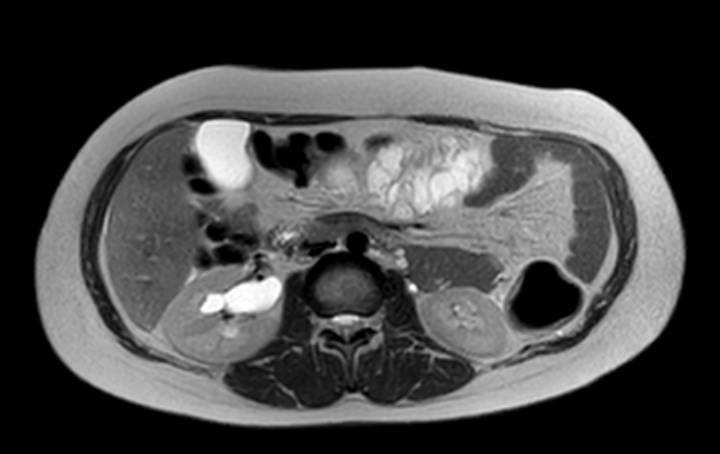 Colon adenocarcinoma with Krukenberg tumors, advanced pregnancy (Radiopaedia 67279-76645 Axial T2 49).jpg