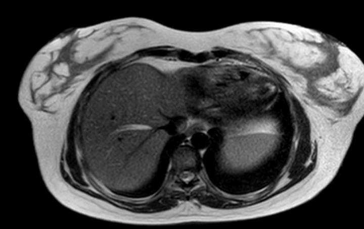 Colon adenocarcinoma with Krukenberg tumors, advanced pregnancy (Radiopaedia 67279-76645 Axial T2 77).jpg