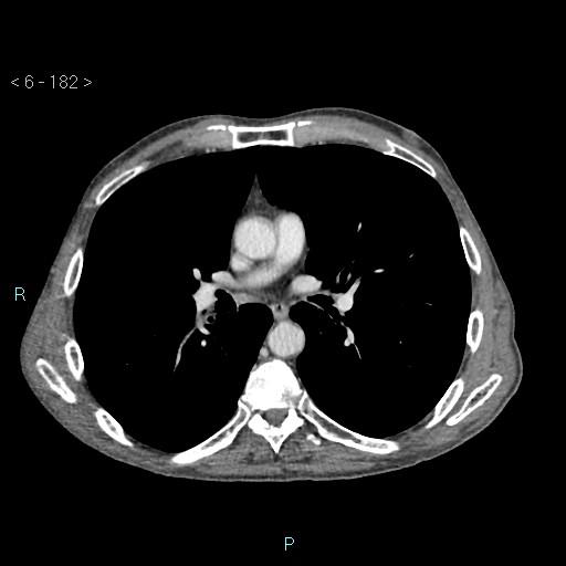 File:Colonic cancer (ultrasound and TC imaging) (Radiopaedia 50346-55713 B 182).jpg