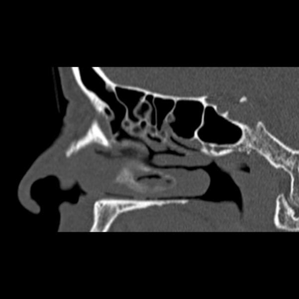 Nasal septal perforation (Radiopaedia 25030-25289 Sagittal bone window 17).jpg