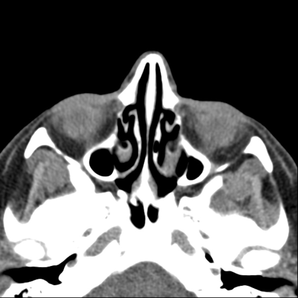 Nasolabial cyst (Radiopaedia 33987-35205 Axial non-contrast 27).jpg