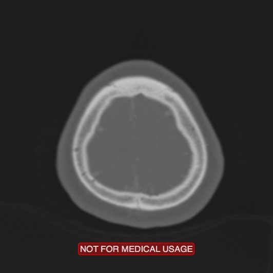 Nasopharyngeal carcinoma recurrence - skull base destruction (Radiopaedia 29107-29490 Axial bone window 13).jpg