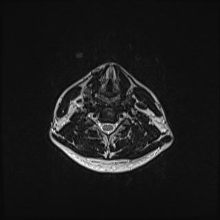Nasopharyngeal carcinoma with perineural spread (Radiopaedia 55030-61380 Axial T2 62).jpg