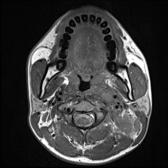 File:Nasopharyngeal carcinoma with skull base invasion (Radiopaedia 53415-59485 Axial T1 39).jpg