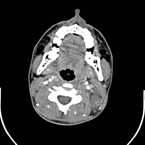 Nasopharyngeal carcinoma with skull base invasion (Radiopaedia 53415-59705 A 101).jpg