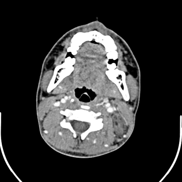 File:Nasopharyngeal carcinoma with skull base invasion (Radiopaedia 53415-59705 A 104).jpg
