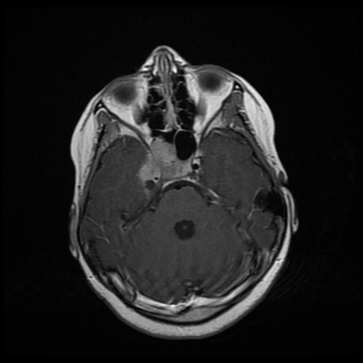 File:Nasopharyngeal rhabdomyosarcoma (Radiopaedia 23417-23486 Axial T1 C+ 11).jpg