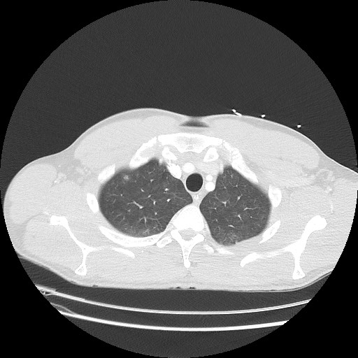 Near-drowning pulmonary edema (Radiopaedia 59457-66814 Axial lung window 9).jpg