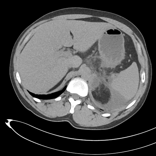 File:Necrotizing pancreatitis with acute necrotic collections (Radiopaedia 38829-41012 Axial non-contrast 22).png