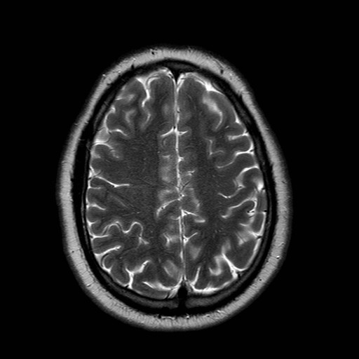 File:Neuro-Behcet's disease (Radiopaedia 21557-21506 Axial T2 21).jpg