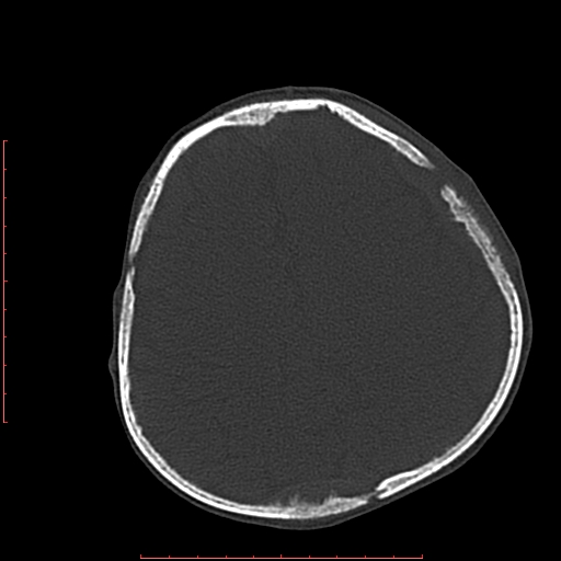 File:Neuroblastoma skull metastasis (Radiopaedia 56053-62683 Axial bone window 19).jpg