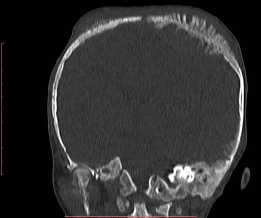File:Neuroblastoma skull metastasis (Radiopaedia 56053-62683 Coronal bone window 22).jpg