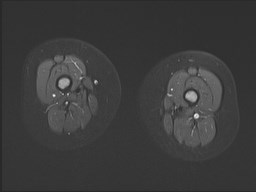 File:Neuroblastoma with bone metastases (Radiopaedia 67080-76414 Axial STIR 23).jpg