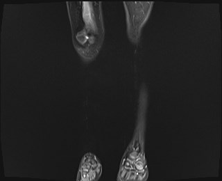 File:Neuroblastoma with bone metastases (Radiopaedia 67080-76414 B 1).jpg