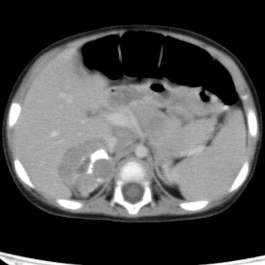 Neuroblastoma with skull metastases (Radiopaedia 30326-30960 C 16).jpg