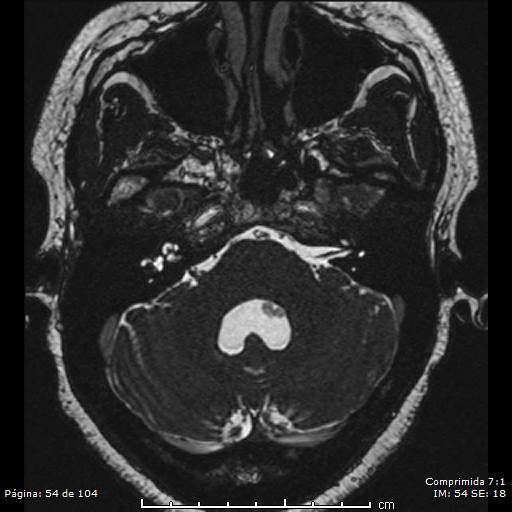 Neurocysticercosis (Radiopaedia 58636-65832 I 54).jpg