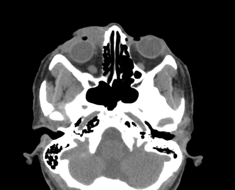 Neurofibromatosis type 1- orbital manifestations (Radiopaedia 49391-54511 Axial non-contrast 41).jpg