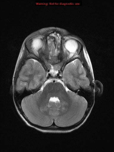 File:Neurofibromatosis type 1 with optic nerve glioma (Radiopaedia 16288-15965 Axial T2 18).jpg
