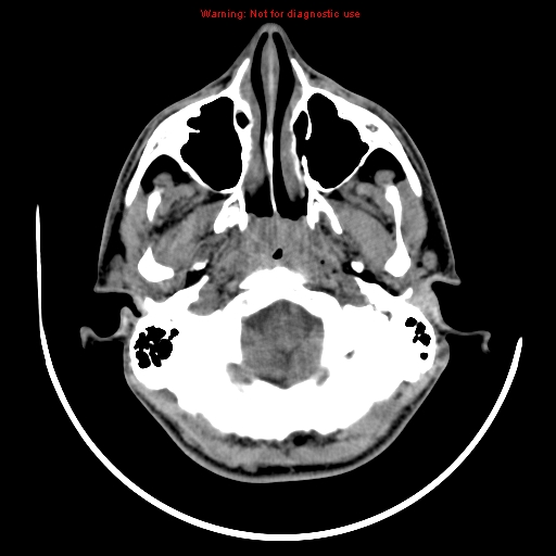File:Neurofibromatosis type 2 (Radiopaedia 8953-9732 Axial non-contrast 2).jpg