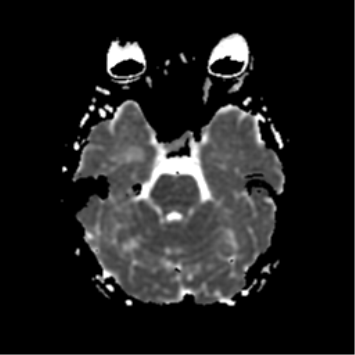 File:Neurofibromatosis type 2 - bilateral acoustic neuromata (Radiopaedia 40060-42566 Axial ADC 7).png