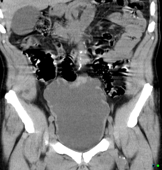 File:Neurogenic bladder - CT findings (Christmas tree bladder) (Radiopaedia 26995-27174 Coronal non-contrast 4).jpg