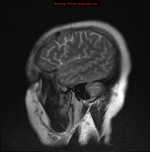 File:Neuroglial cyst (Radiopaedia 10713-11184 Sagittal T2 4).jpg