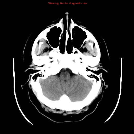 File:Neuroglial cyst (Radiopaedia 10713-11185 Axial non-contrast 27).jpg