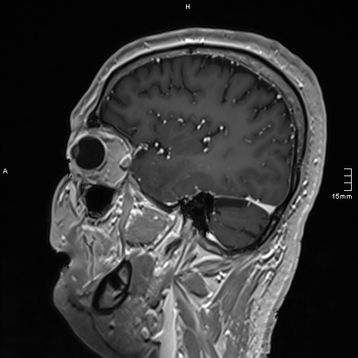 Neurosarcoidosis - involvement of the mesial temporal lobes (Radiopaedia 67429-76820 Sagittal T1 C+ 47).jpg