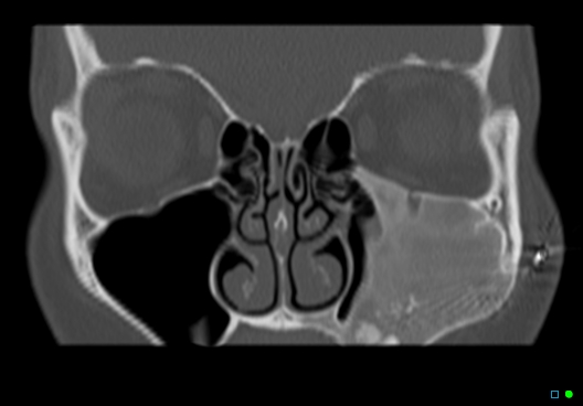 File:Neurostimulators for facial pain- underlying fibrous dysplasia (Radiopaedia 27549-27754 Coronal bone window 1).jpg