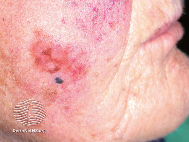File:Nodular melanoma in lentigo maligna (DermNet NZ lesions-mel13).jpg